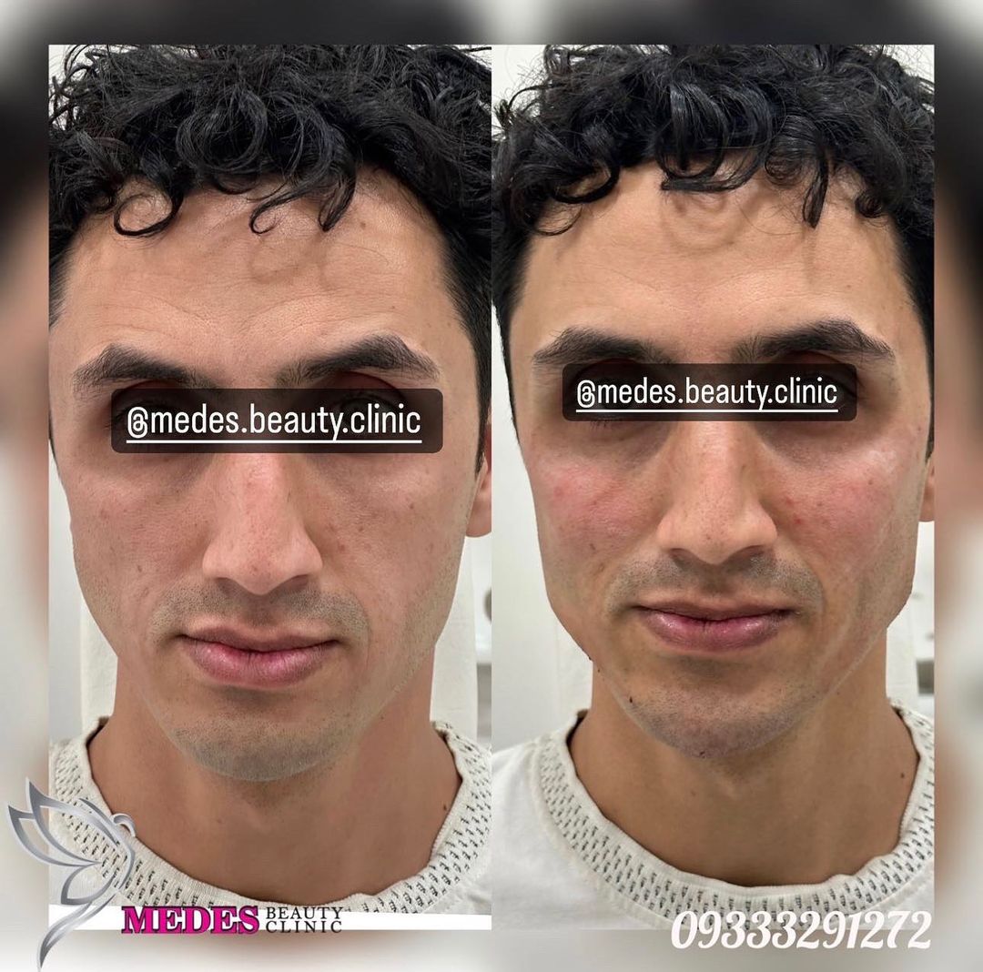 گالری زاویه سازی صورت